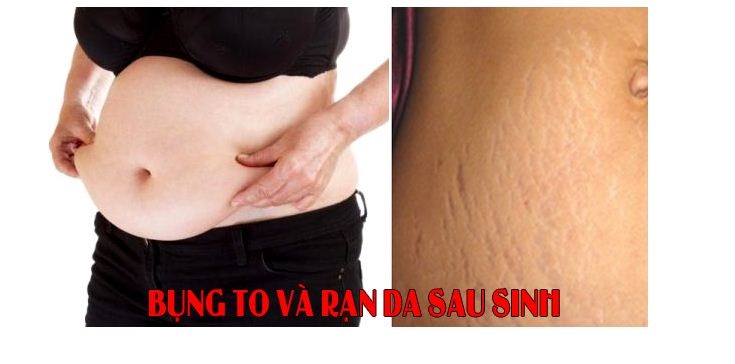 Bụng to và rạn da là vấn đề gặp phải của hầu hết các bà mẹ sau khi sinh